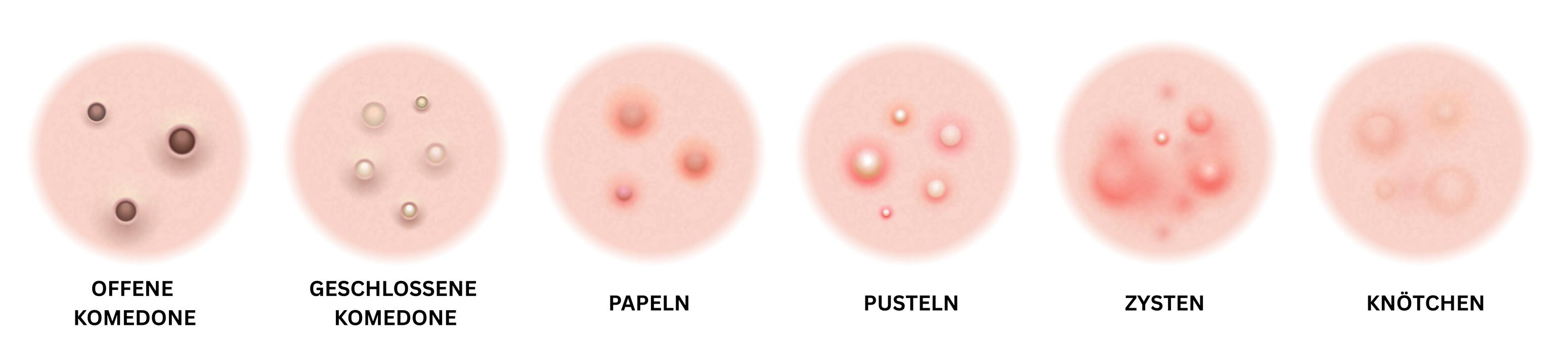 Die Infografik zeigt die verschiedenen Schweregrade von Akne von leichten Mitessern und Whiteheads über entzündete Papeln und Pusteln bis hin zu schweren Zysten und Knoten, dargestellt entlang einer Skala von mild bis schwer.